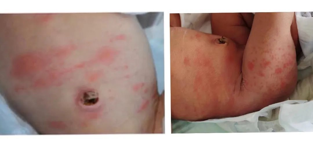 新生兒紅斑.jpg 新生兒紅斑.jpg