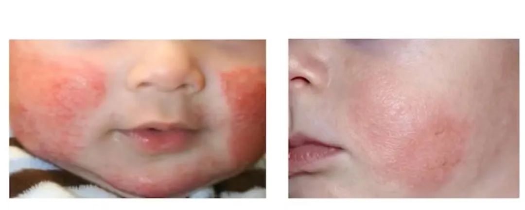 濕疹.jpg 濕疹.jpg